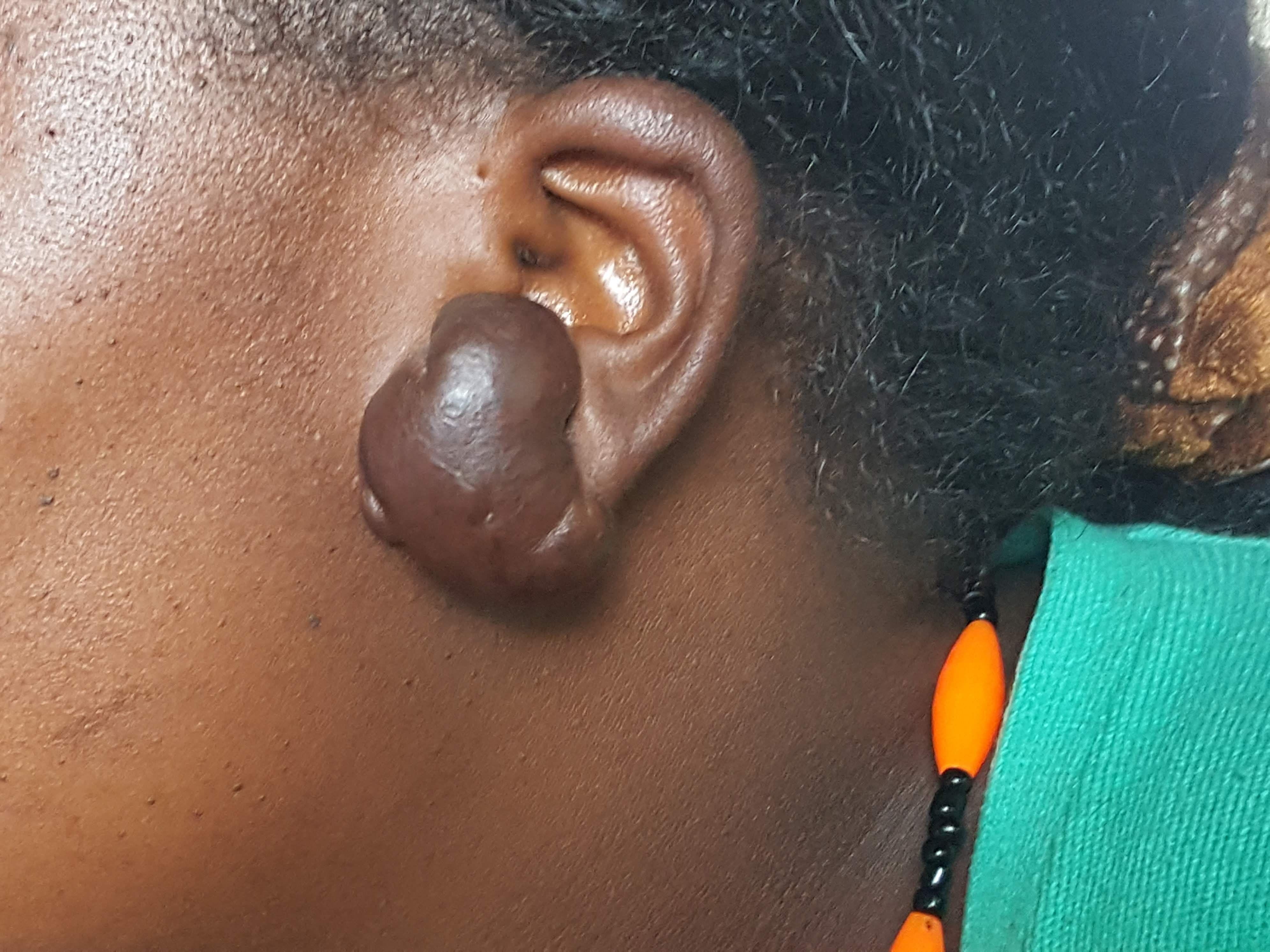 Boy With A Lump On His Ear
